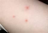 Bed Bug Bite Picture