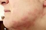 Bed Bugs Pictures Of Bites Pictures