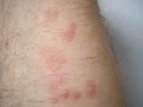 Pictures of Bed Bugs Rash Pictures