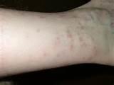Pictures Of Bed Bugs Bites Images
