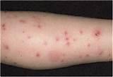 Pictures of Bed Bug Bite Picture