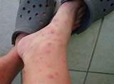 Bed Bug Bites Vs Mosquito Bites Photos