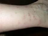 Pictures of Bed Bugs Bites Photos