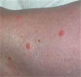 Bed Bug Bite Photo Photos