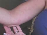 Bed Bug Bite Picture Images