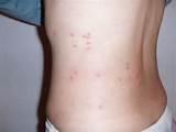 Images of Bed Bugs Pictures Of Bites