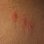 Bed Bug Bite Picture Pictures