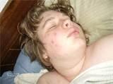 Bed Bugs Bite Pictures Pictures