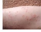 Bed Bug Rash Pictures Images