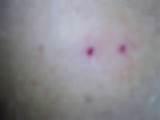 Bed Bugs Bite Pictures Images