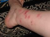 Photos of Bed Bug Rash Pictures