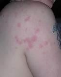 Photos of Bed Bug Rash Pictures