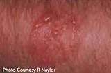 Bed Bug Rash Pictures Photos