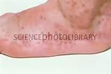 Bed Bug Rash Pictures Pictures
