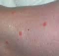 Photos of How To Identify Bed Bug Bites
