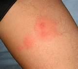 How Do Bed Bug Bites Look Images