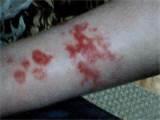Images Of Bed Bugs Images