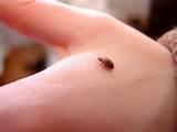Bed Bugs Bites Symptoms Images