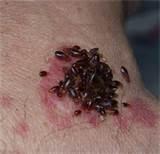 Photos of Bed Bugs Bites