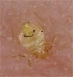 Images of Bed Bugs Bites