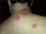 Photos of Bug Bites In Bed