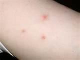 Bed Bug Sores Pictures