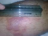 Pictures of Bed Bug Rash