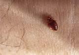 Treatment Of Bed Bugs Images