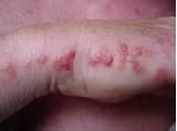 Bed Bugs Symptoms Pictures