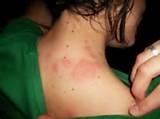 Pictures of Bed Bugs Symptoms