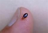 Images of Bed Bugs Causes