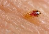 Stop Bed Bugs