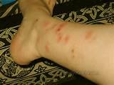Bed Bug Infestation Pictures