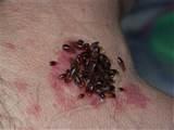 Bed Bugs How Do You Get Them Photos Bed Bugs How Do You Get Them Photos