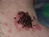 Bed Bugs Feed Pictures